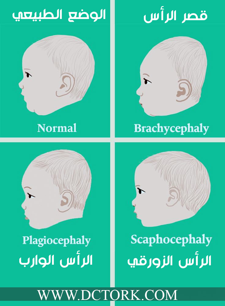 العلاماتُ غير الطبيعيةِ في رأس المولود