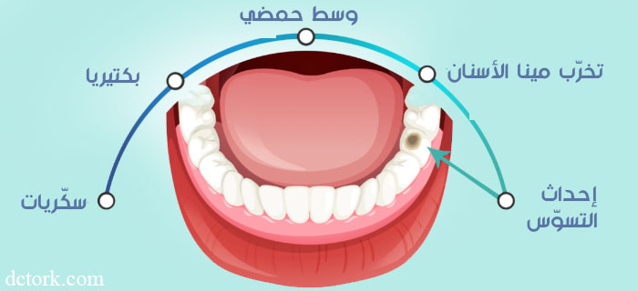 كيف يحدث تسوس الأسنان ؟